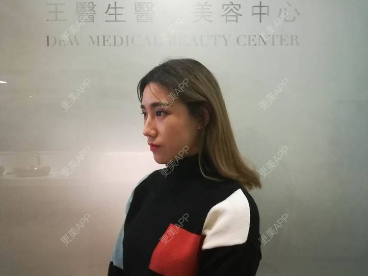 更美 - 更美用户CgtfiDRXHz的自体脂肪丰苹果肌经验 | 自体脂肪全面部填充 | 哈尔滨