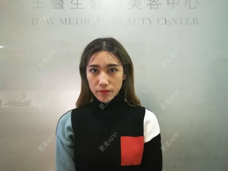 更美 - 更美用户CgtfiDRXHz的自体脂肪丰苹果肌经验 | 自体脂肪全面部填充 | 哈尔滨