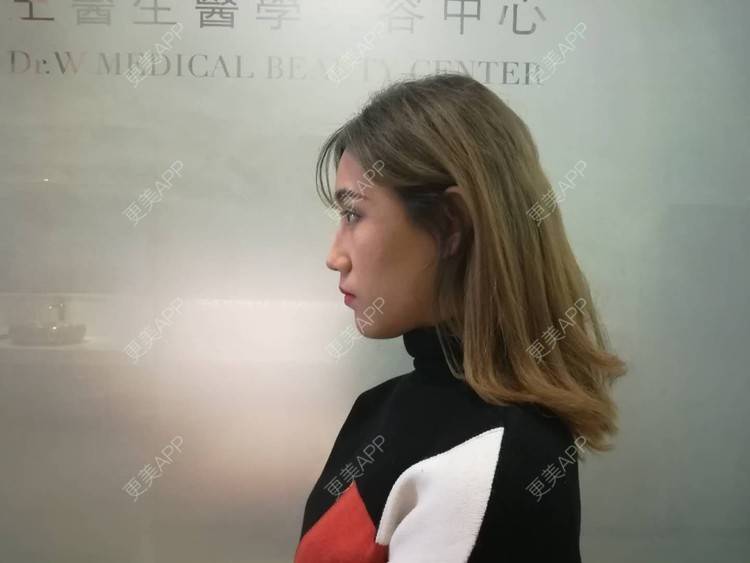 更美 - 更美用户CgtfiDRXHz的自体脂肪丰苹果肌经验 | 自体脂肪全面部填充 | 哈尔滨