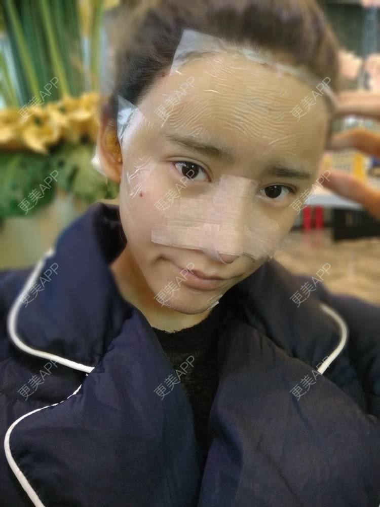 更美 - 更美用户CgtfiDRXHz的自体脂肪丰苹果肌经验 | 哈尔滨 | 自体脂肪全面部填充