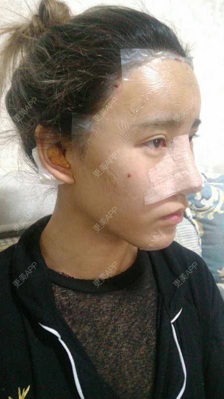 更美 - 更美用户CgtfiDRXHz的自体脂肪丰苹果肌经验 | 哈尔滨 | 自体脂肪全面部填充