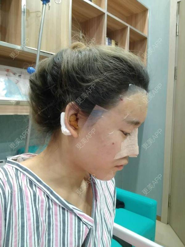 更美 - 更美用户CgtfiDRXHz的自体脂肪丰苹果肌经验 | 哈尔滨 | 自体脂肪全面部填充