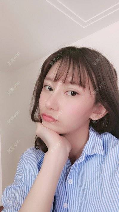 更美 - 更美用户58UrXXkMuu的鼻部多项经验 | 鼻部多项 | 鼻翼缩小 | 人工骨隆鼻 | 长鼻矫正 | 自体肋软骨垫鼻基底 | 福州