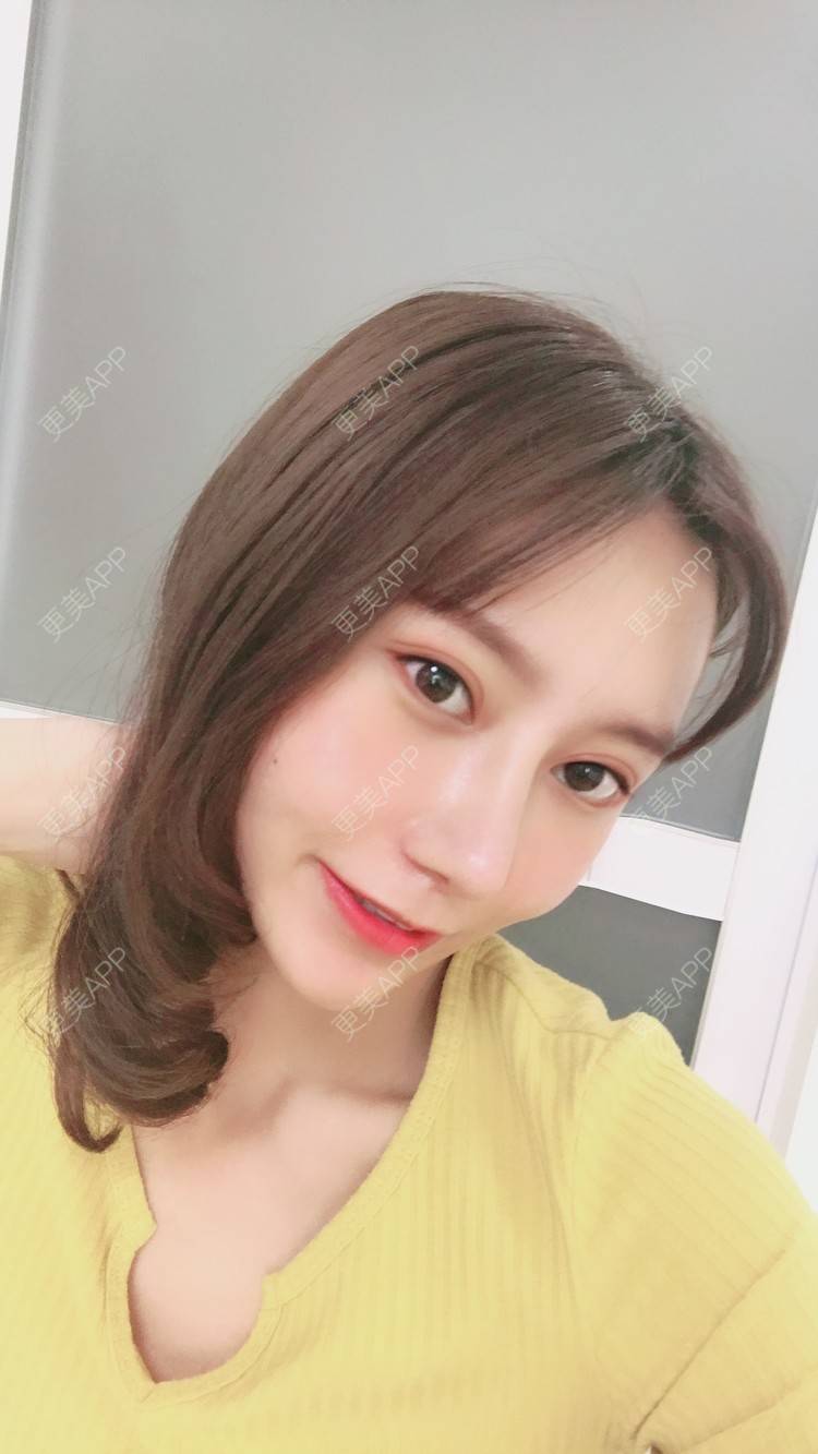更美 - 更美用户58UrXXkMuu的鼻部多项经验 | 鼻部多项 | 鼻翼缩小 | 人工骨隆鼻 | 长鼻矫正 | 自体肋软骨垫鼻基底 | 福州