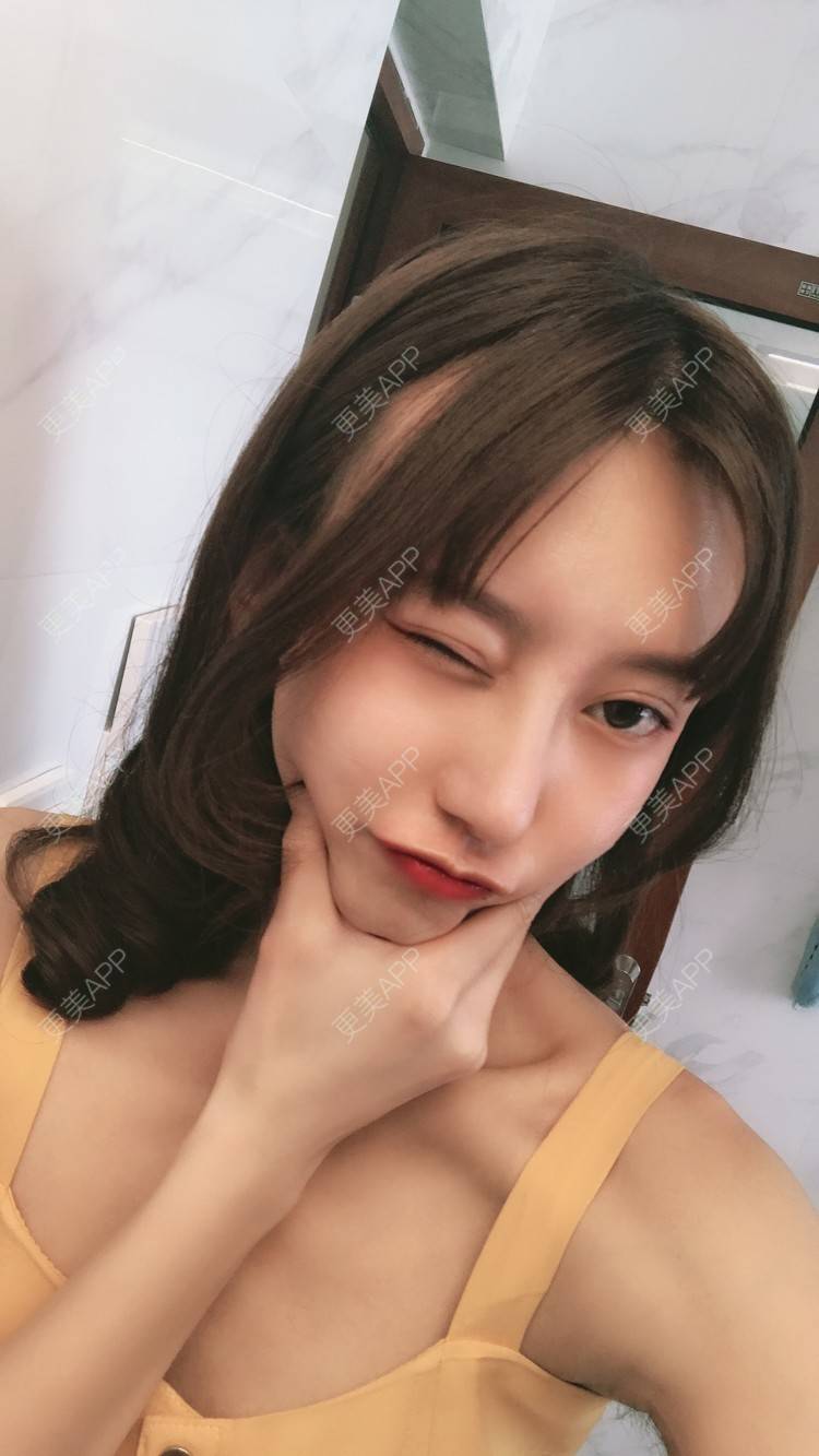 更美 - 更美用户58UrXXkMuu的鼻部多项经验 | 鼻部多项 | 鼻翼缩小 | 人工骨隆鼻 | 长鼻矫正 | 自体肋软骨垫鼻基底 | 福州