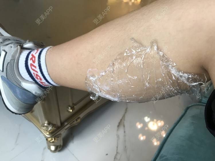 更美 - 婷啊婷tt的除皱瘦脸经验 | 除皱瘦脸 | 注射塑形腿部 | 长沙
