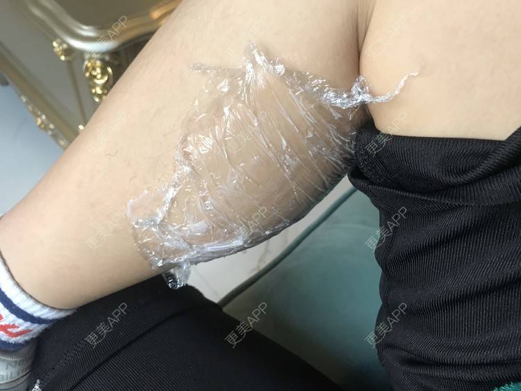 更美 - 婷啊婷tt的除皱瘦脸经验 | 除皱瘦脸 | 注射塑形腿部 | 长沙