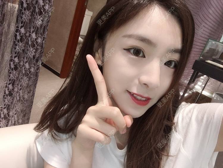 更美 - 更美用户PCeRKxunmA的膨体垫下巴经验 | 上海 | 膨体垫下巴