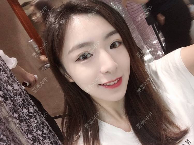 更美 - 更美用户PCeRKxunmA的膨体垫下巴经验 | 上海 | 膨体垫下巴