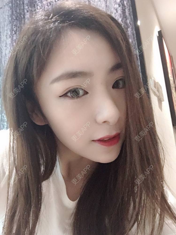 更美 - 更美用户PCeRKxunmA的膨体垫下巴经验 | 上海 | 膨体垫下巴