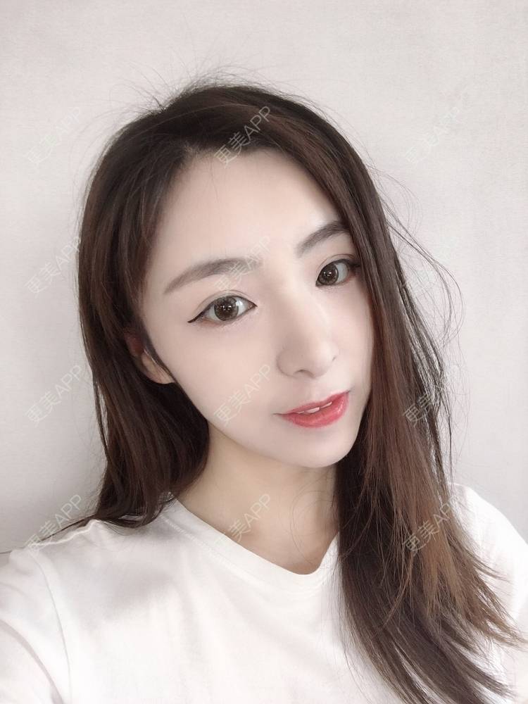 更美 - 更美用户PCeRKxunmA的膨体垫下巴经验 | 上海 | 膨体垫下巴