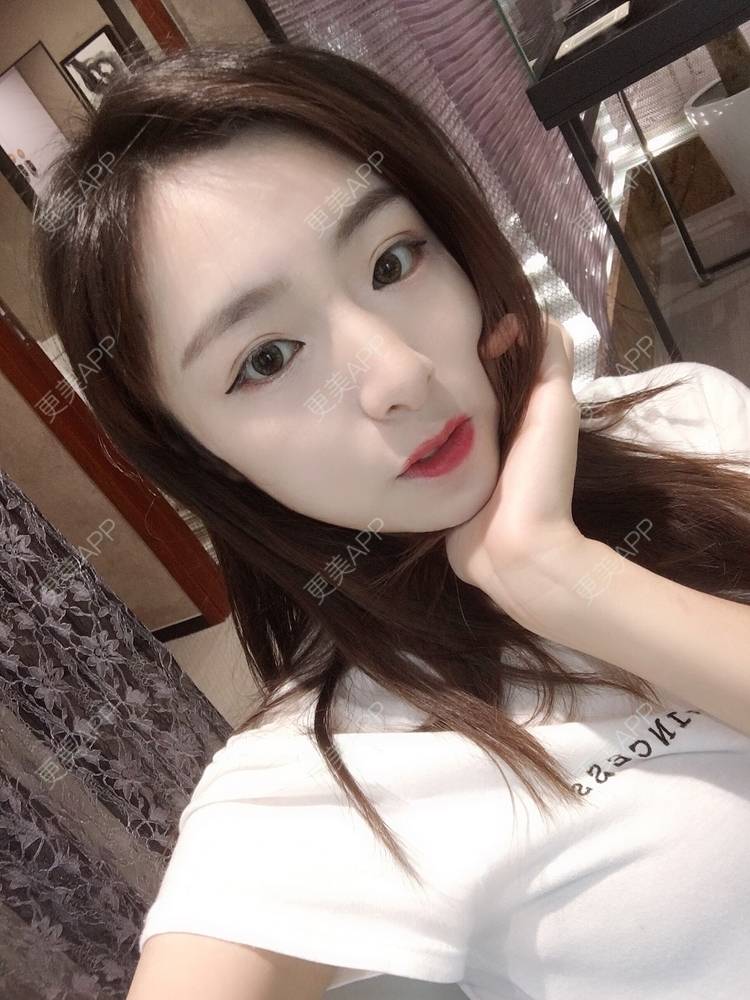 更美 - 更美用户PCeRKxunmA的膨体垫下巴经验 | 上海 | 膨体垫下巴