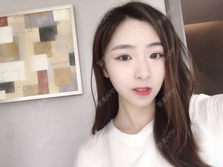 更美 - 更美用户PCeRKxunmA的膨体垫下巴经验 | 上海 | 膨体垫下巴