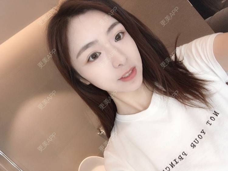 更美 - 更美用户PCeRKxunmA的膨体垫下巴经验 | 上海 | 膨体垫下巴