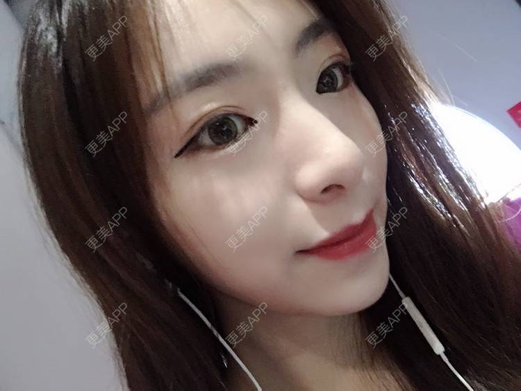 更美 - 更美用户PCeRKxunmA的膨体垫下巴经验 | 上海 | 膨体垫下巴