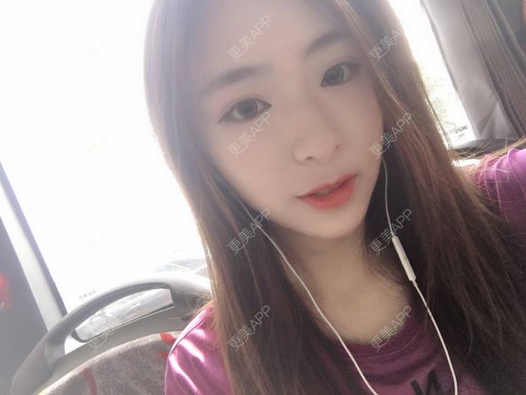 更美 - 更美用户PCeRKxunmA的膨体垫下巴经验 | 上海 | 膨体垫下巴