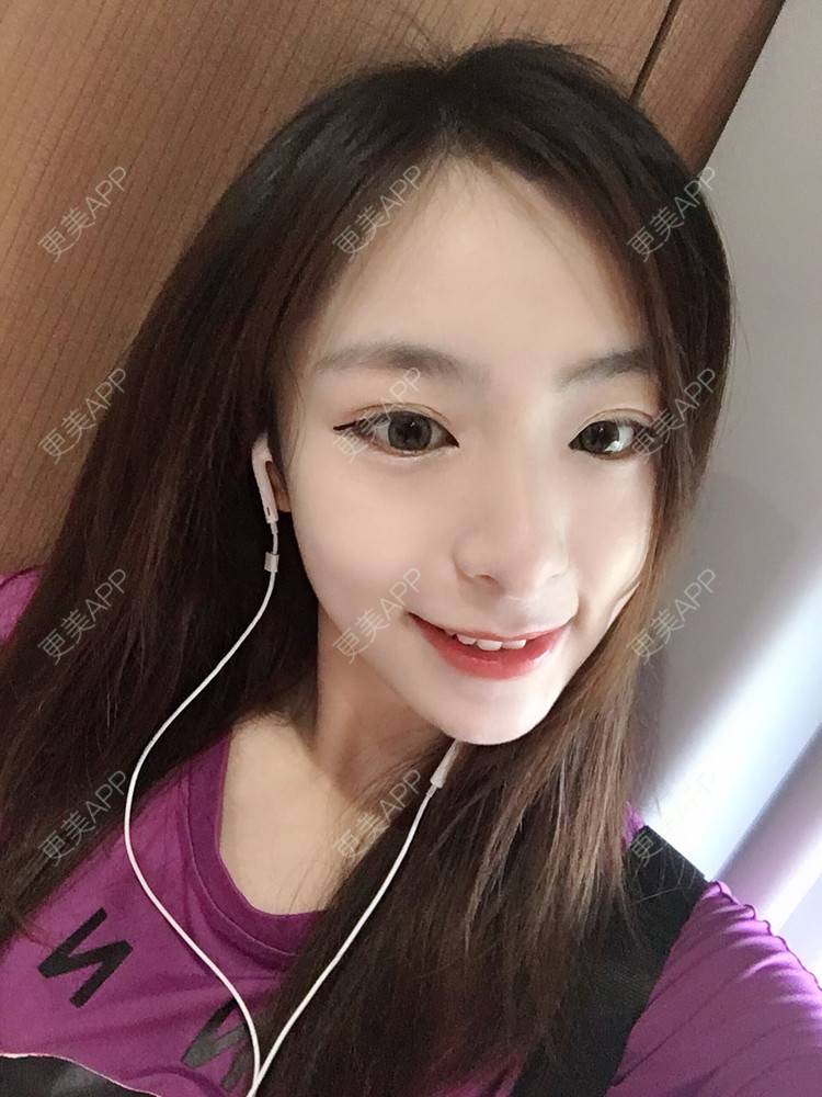 更美 - 更美用户PCeRKxunmA的膨体垫下巴经验 | 上海 | 膨体垫下巴