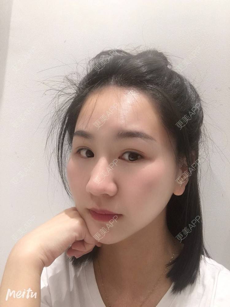 更美 - 怡你在这里吖的鼻部多项经验 | 鼻部多项 | 自体软骨垫鼻尖 | 鼻翼缩小 | 重庆 | 鼻中隔软骨隆鼻 | 耳软骨隆鼻