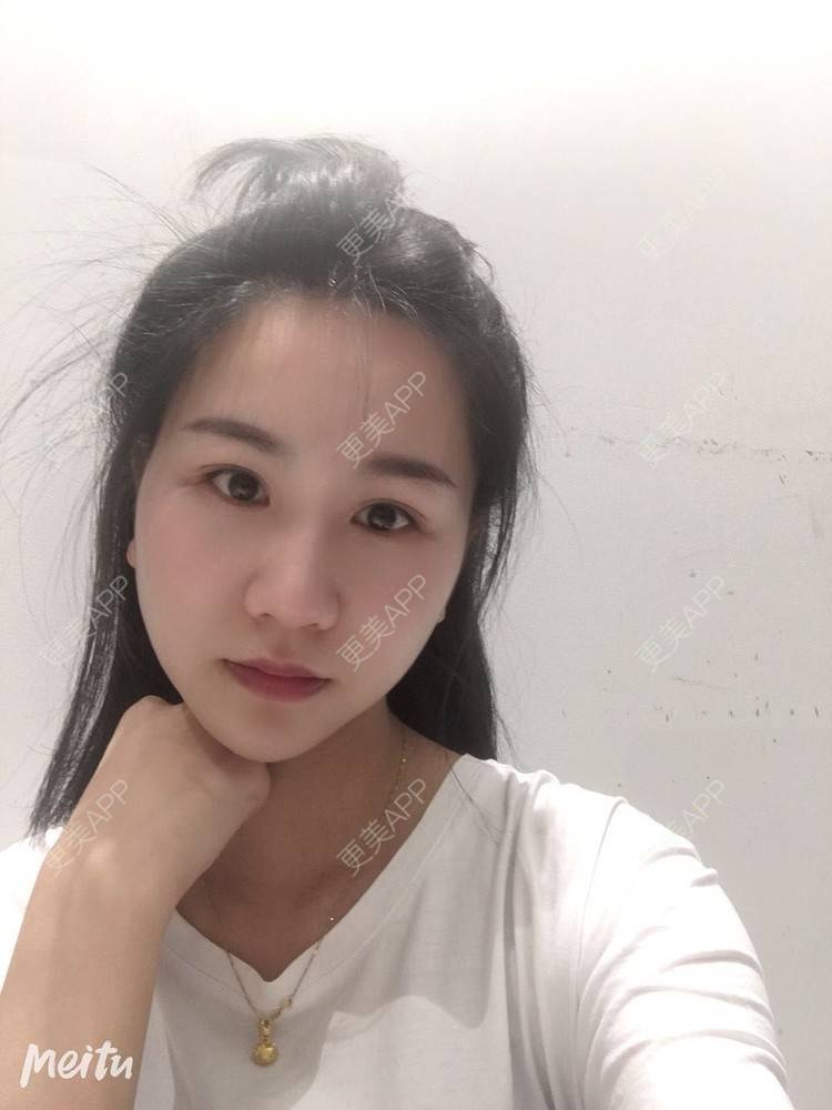 更美 - 怡你在这里吖的鼻部多项经验 | 鼻部多项 | 自体软骨垫鼻尖 | 鼻翼缩小 | 重庆 | 鼻中隔软骨隆鼻 | 耳软骨隆鼻