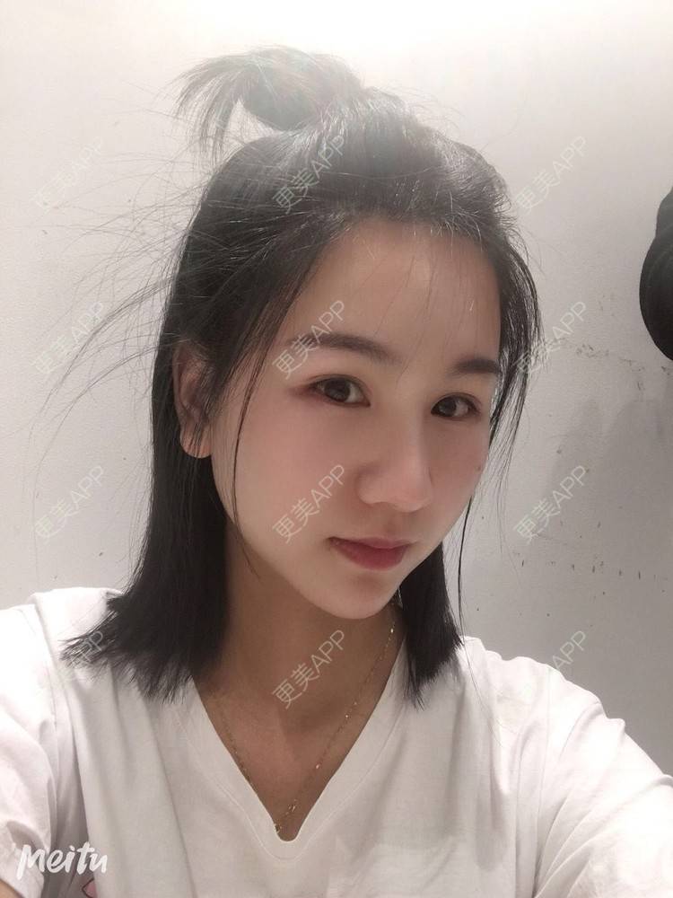 更美 - 怡你在这里吖的鼻部多项经验 | 鼻部多项 | 自体软骨垫鼻尖 | 鼻翼缩小 | 重庆 | 鼻中隔软骨隆鼻 | 耳软骨隆鼻