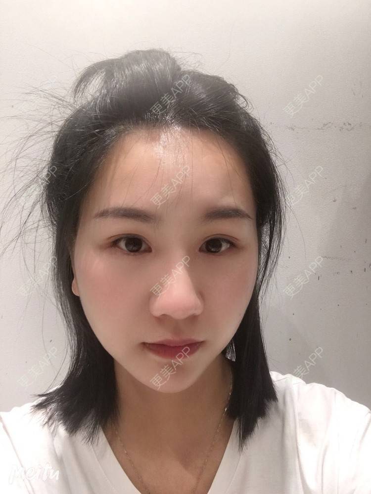 更美 - 怡你在这里吖的鼻部多项经验 | 鼻部多项 | 自体软骨垫鼻尖 | 鼻翼缩小 | 重庆 | 鼻中隔软骨隆鼻 | 耳软骨隆鼻