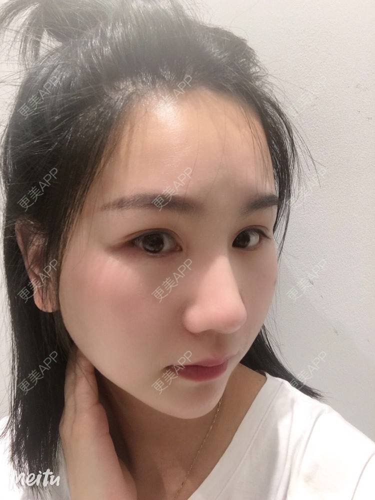 更美 - 怡你在这里吖的鼻部多项经验 | 鼻部多项 | 自体软骨垫鼻尖 | 鼻翼缩小 | 重庆 | 鼻中隔软骨隆鼻 | 耳软骨隆鼻