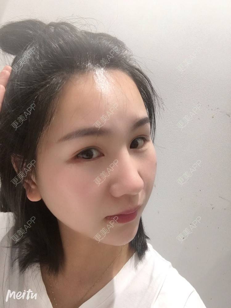更美 - 怡你在这里吖的鼻部多项经验 | 鼻部多项 | 自体软骨垫鼻尖 | 鼻翼缩小 | 重庆 | 鼻中隔软骨隆鼻 | 耳软骨隆鼻