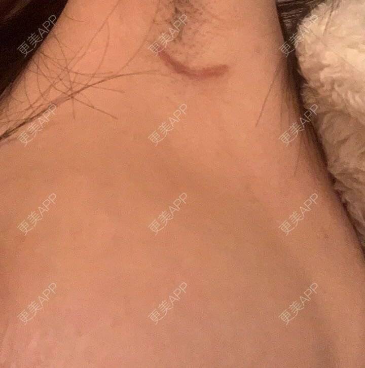 更美 - MoJito.的假体隆胸经验 | 假体隆胸 | 成都