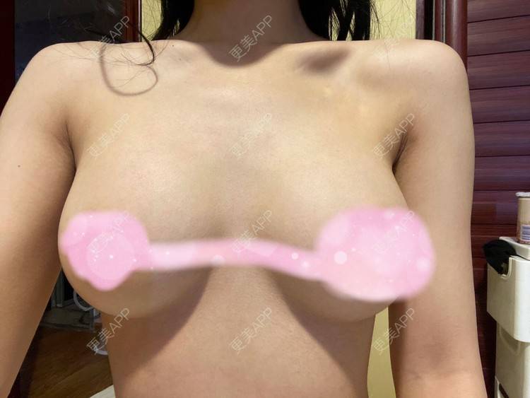 更美 - MoJito.的假体隆胸经验 | 假体隆胸 | 成都