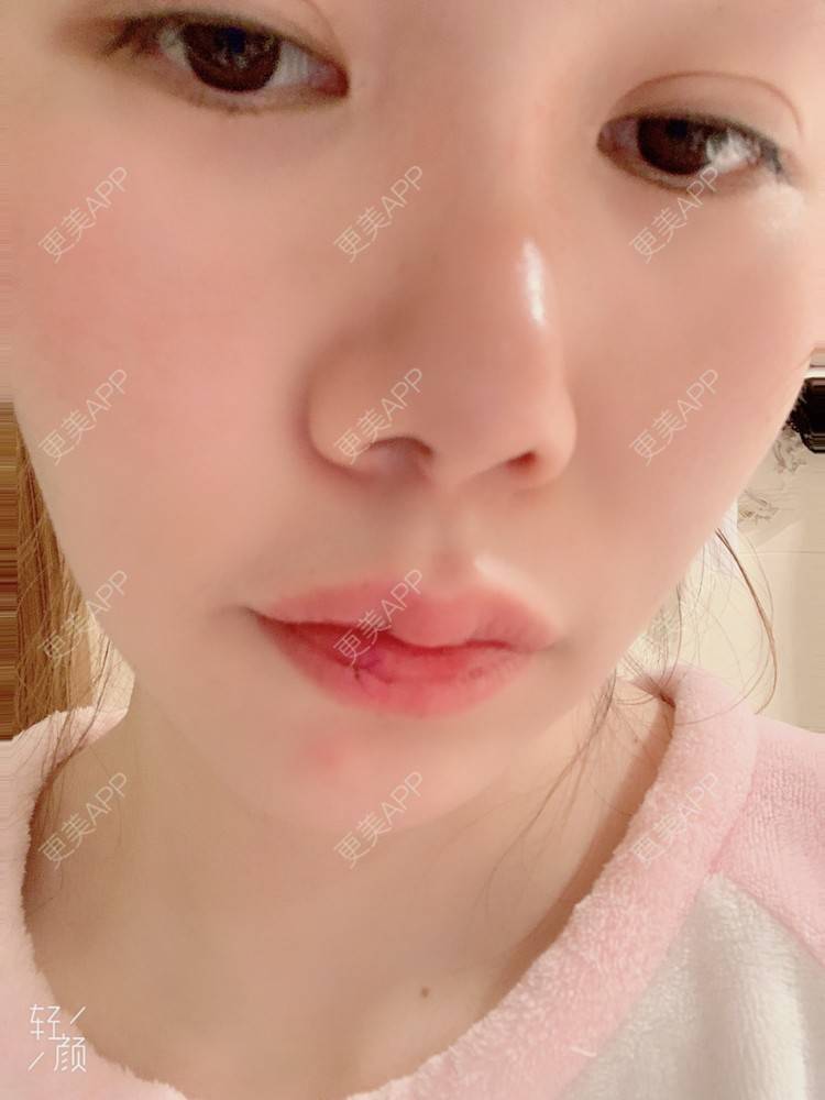 更美 - 浃浃！的厚唇改薄经验 | 厚唇改薄 | 上海