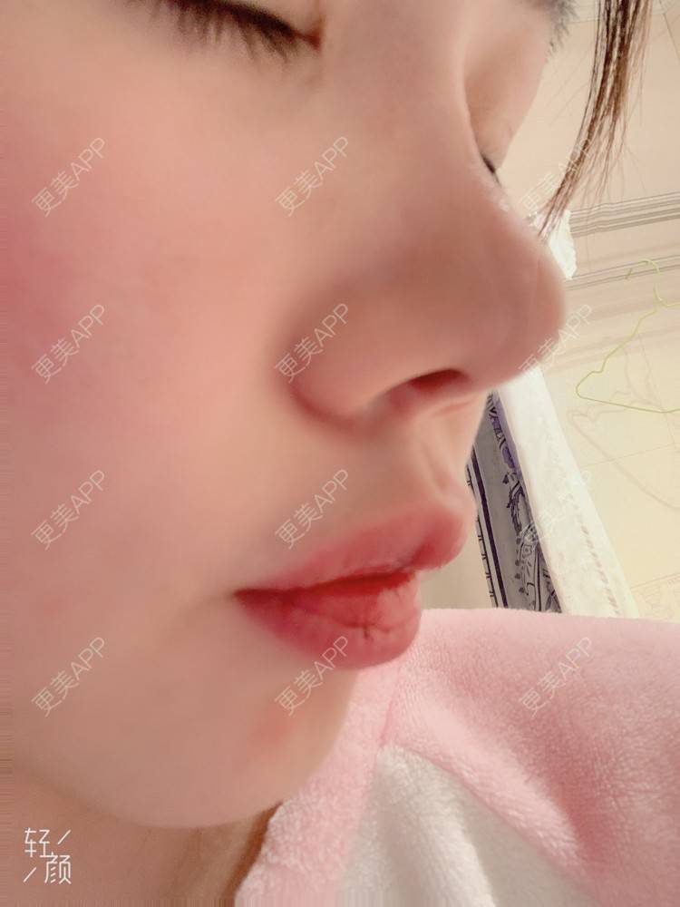 更美 - 浃浃！的厚唇改薄经验 | 厚唇改薄 | 上海