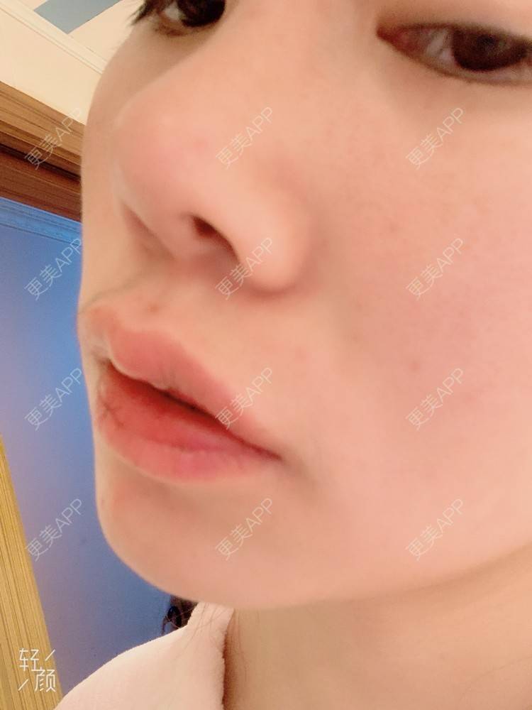 更美 - 浃浃！的厚唇改薄经验 | 厚唇改薄 | 上海