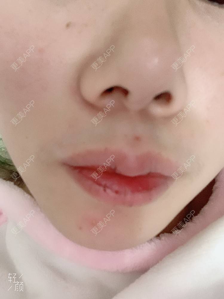 更美 - 浃浃！的厚唇改薄经验 | 厚唇改薄 | 上海