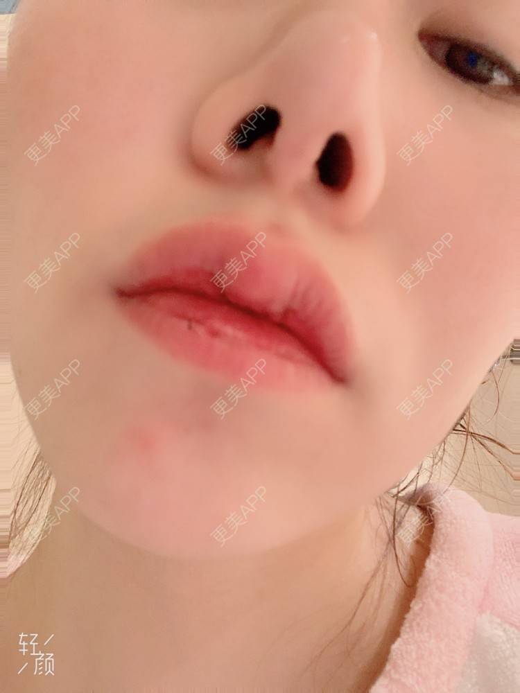 更美 - 浃浃！的厚唇改薄经验 | 厚唇改薄 | 上海