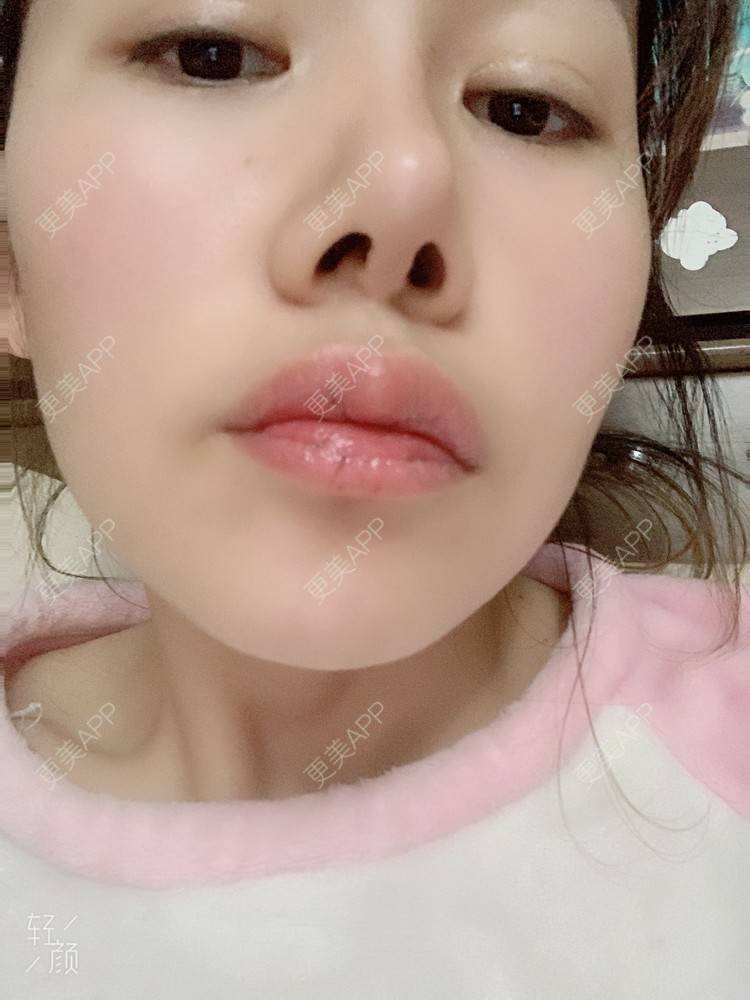 更美 - 浃浃！的厚唇改薄经验 | 厚唇改薄 | 上海