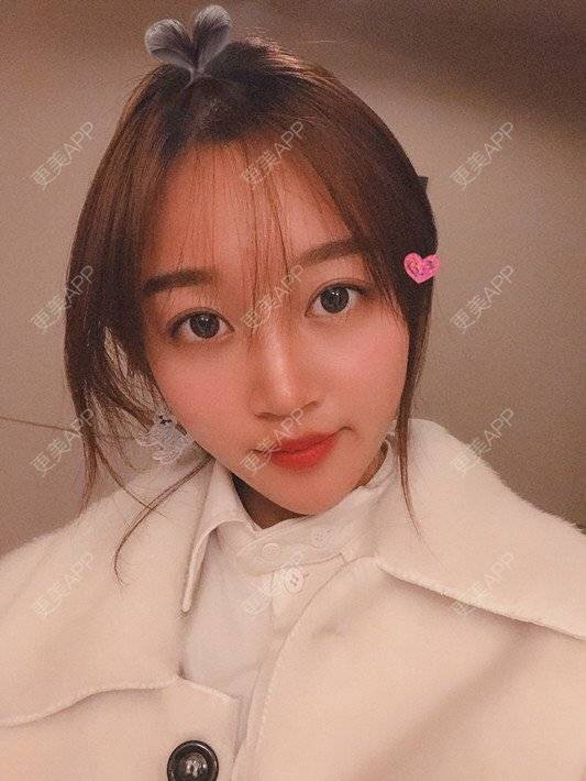 更美 - 更美用户Zi3JeLapMh的自体软骨垫鼻尖经验 | 自体软骨垫鼻尖 | 鼻翼缩小 | 福州 | 假体垫鼻基底 | 人工骨隆鼻 | 长鼻矫正