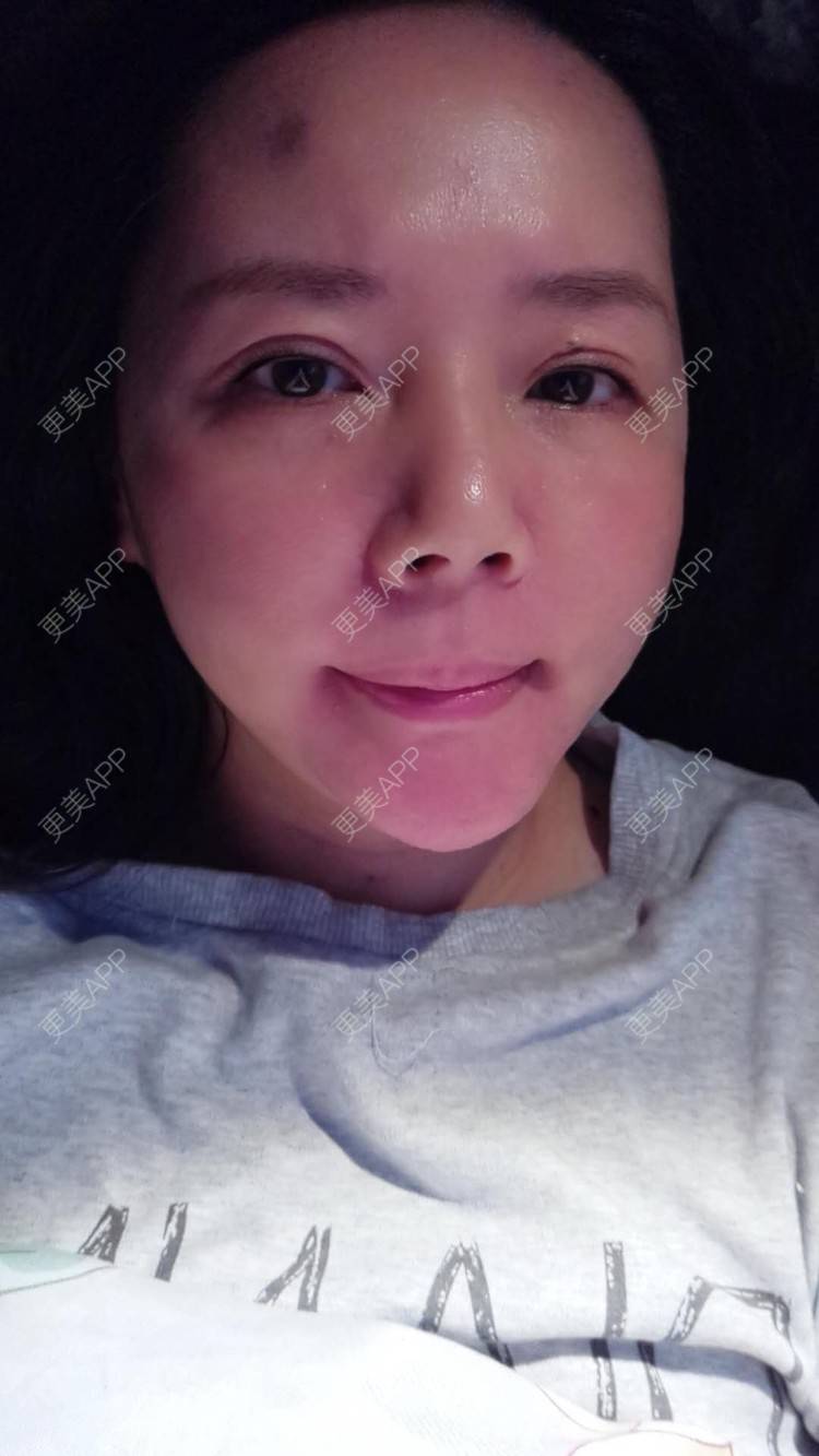 更美 - 更美用户amyZHbrzsl的根管治疗经验 | 上海 | 根管治疗