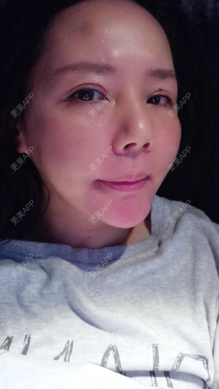 更美 - 更美用户amyZHbrzsl的根管治疗经验 | 上海 | 根管治疗