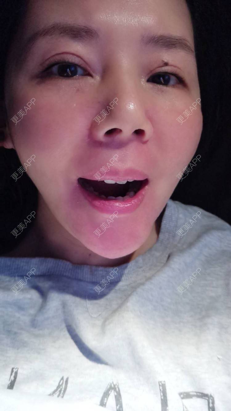 更美 - 更美用户amyZHbrzsl的根管治疗经验 | 上海 | 根管治疗