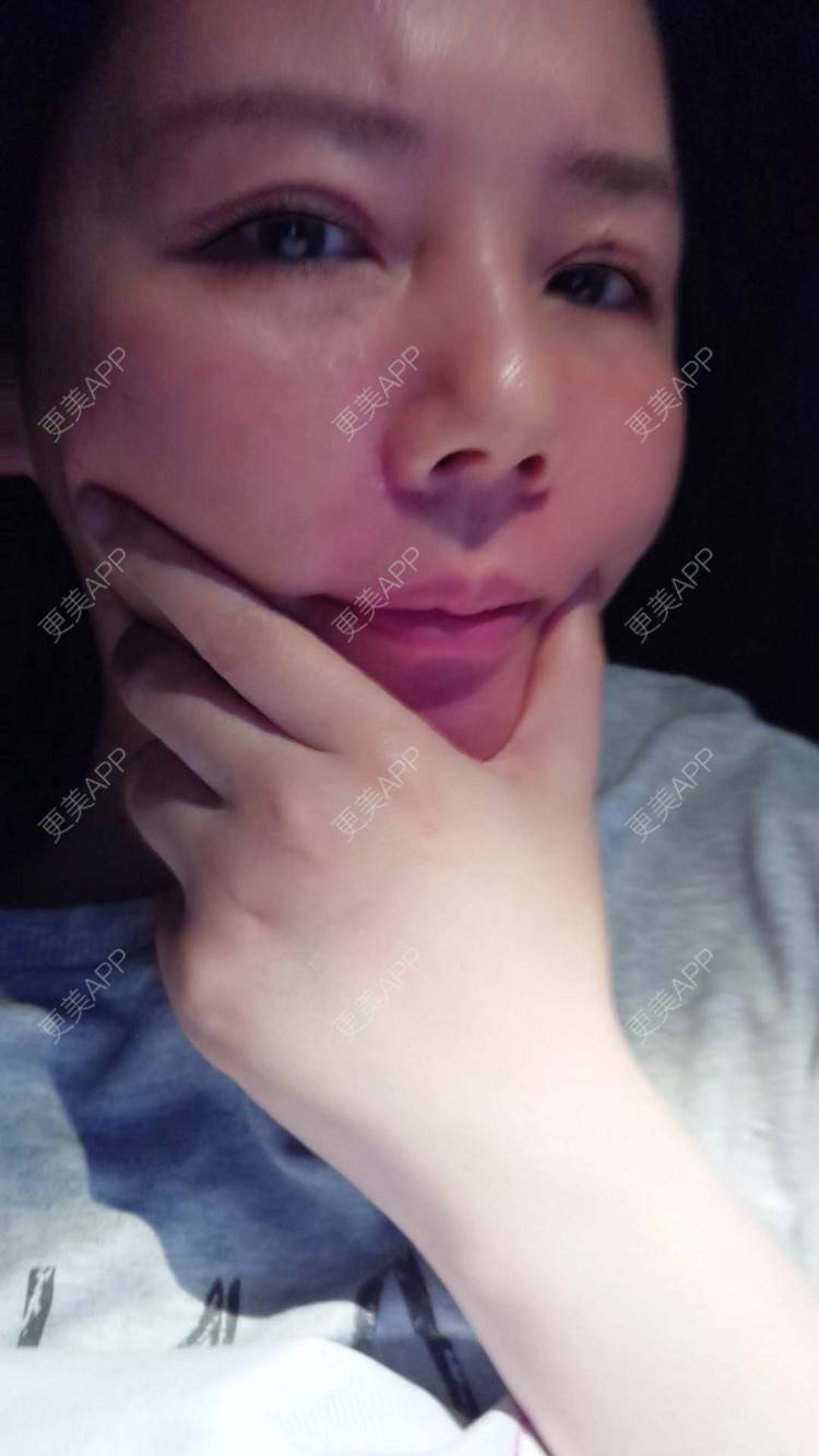 更美 - 更美用户amyZHbrzsl的根管治疗经验 | 上海 | 根管治疗