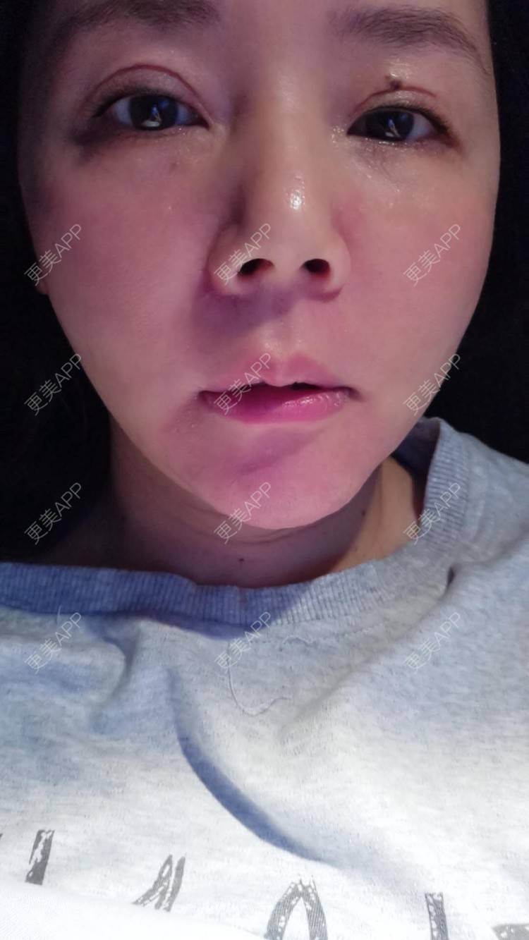更美 - 更美用户amyZHbrzsl的根管治疗经验 | 上海 | 根管治疗