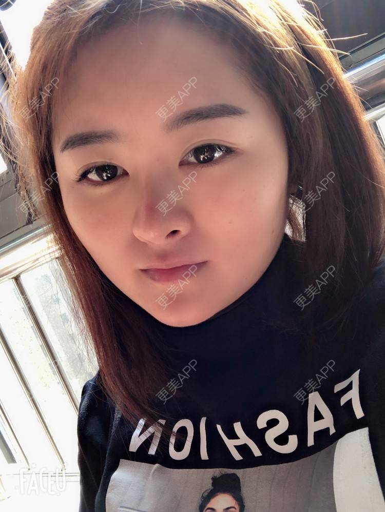 更美 - 浑身上下的肋软骨隆鼻经验 | 更美研究所 | 肋软骨隆鼻 | 杭州