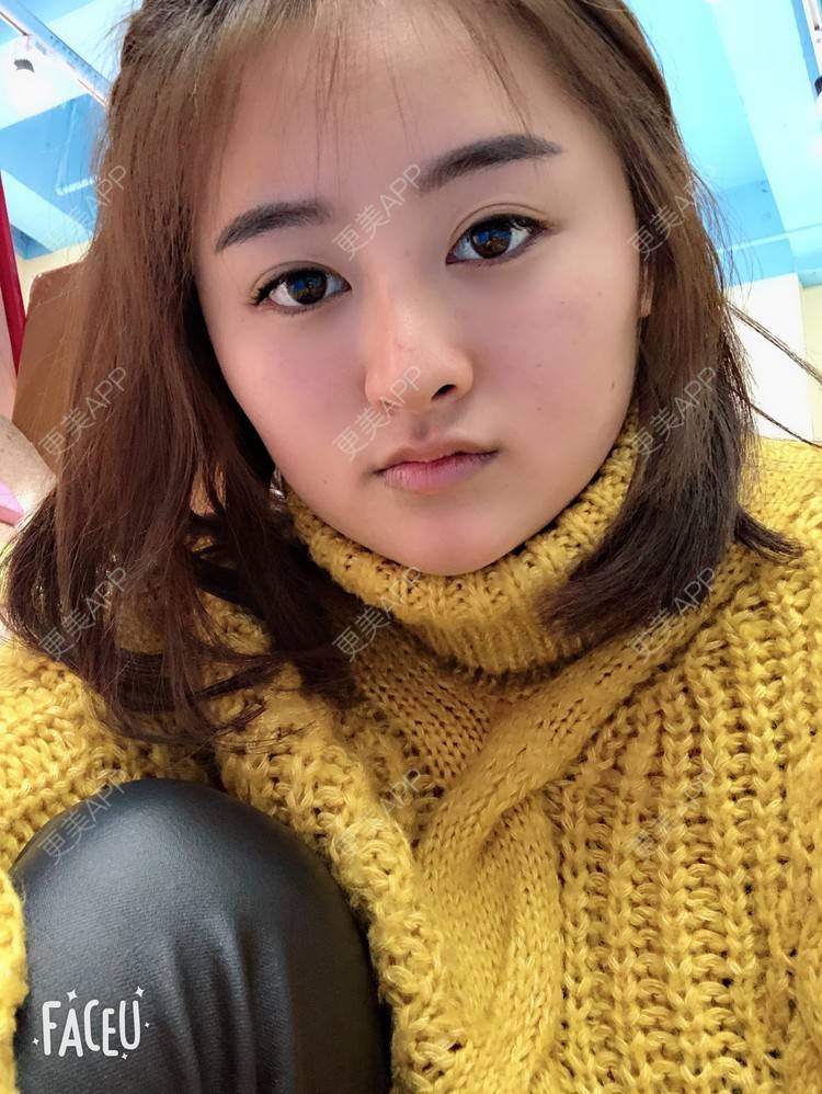 更美 - 浑身上下的肋软骨隆鼻经验 | 更美研究所 | 肋软骨隆鼻 | 杭州