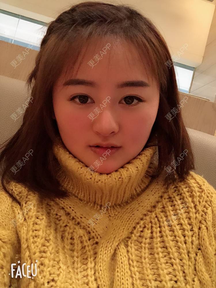 更美 - 浑身上下的肋软骨隆鼻经验 | 更美研究所 | 肋软骨隆鼻 | 杭州