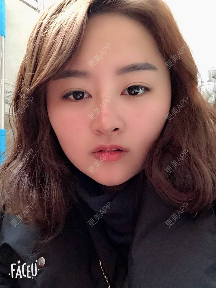 更美 - 浑身上下的肋软骨隆鼻经验 | 更美研究所 | 肋软骨隆鼻 | 杭州