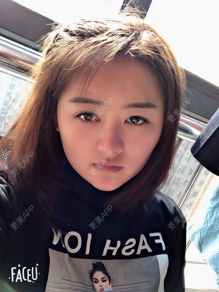 更美 - 浑身上下的肋软骨隆鼻经验 | 更美研究所 | 肋软骨隆鼻 | 杭州