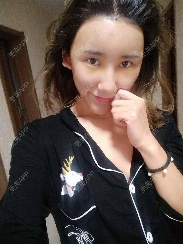 更美 - 更美用户CgtfiDRXHz的自体脂肪丰苹果肌经验 | 自体脂肪全面部填充 | 自体脂肪丰面颊 | 自体脂肪丰太阳穴 | 哈尔滨