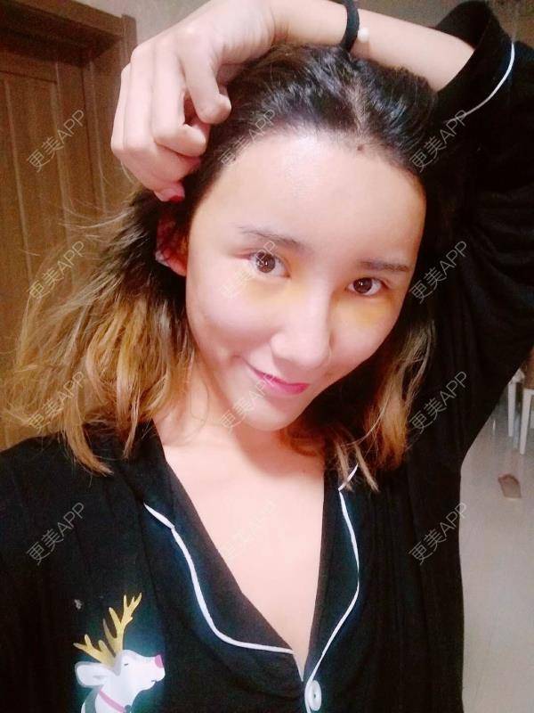 更美 - 更美用户CgtfiDRXHz的自体脂肪丰苹果肌经验 | 自体脂肪全面部填充 | 自体脂肪丰面颊 | 自体脂肪丰太阳穴 | 哈尔滨