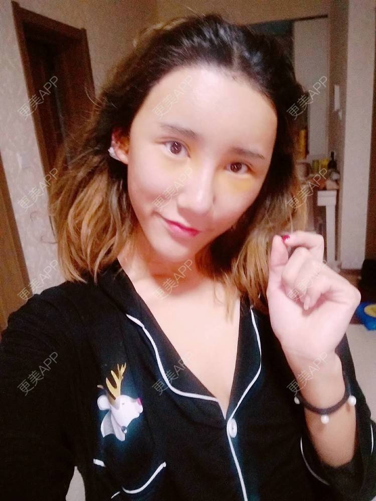 更美 - 更美用户CgtfiDRXHz的自体脂肪丰苹果肌经验 | 自体脂肪全面部填充 | 自体脂肪丰面颊 | 自体脂肪丰太阳穴 | 哈尔滨