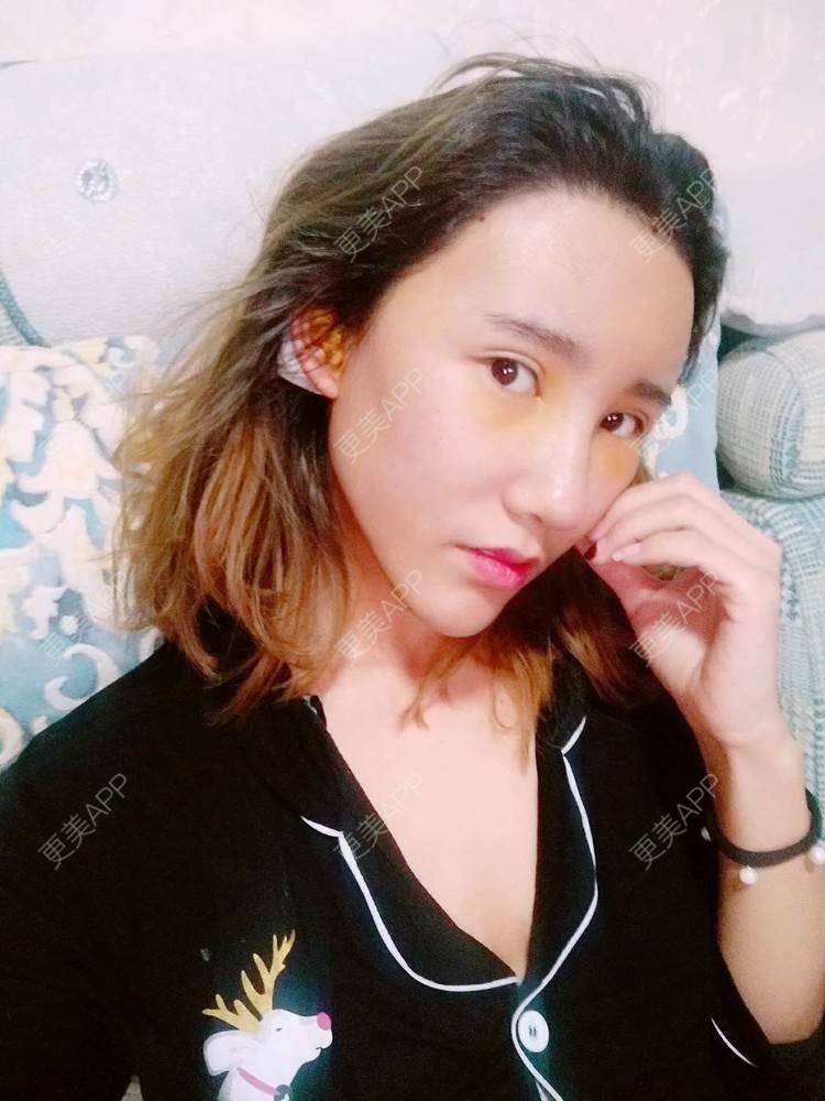 更美 - 更美用户CgtfiDRXHz的自体脂肪丰苹果肌经验 | 自体脂肪全面部填充 | 自体脂肪丰面颊 | 自体脂肪丰太阳穴 | 哈尔滨